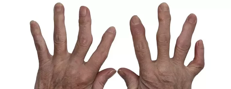 Co można jeść przy dnie moczanowej?